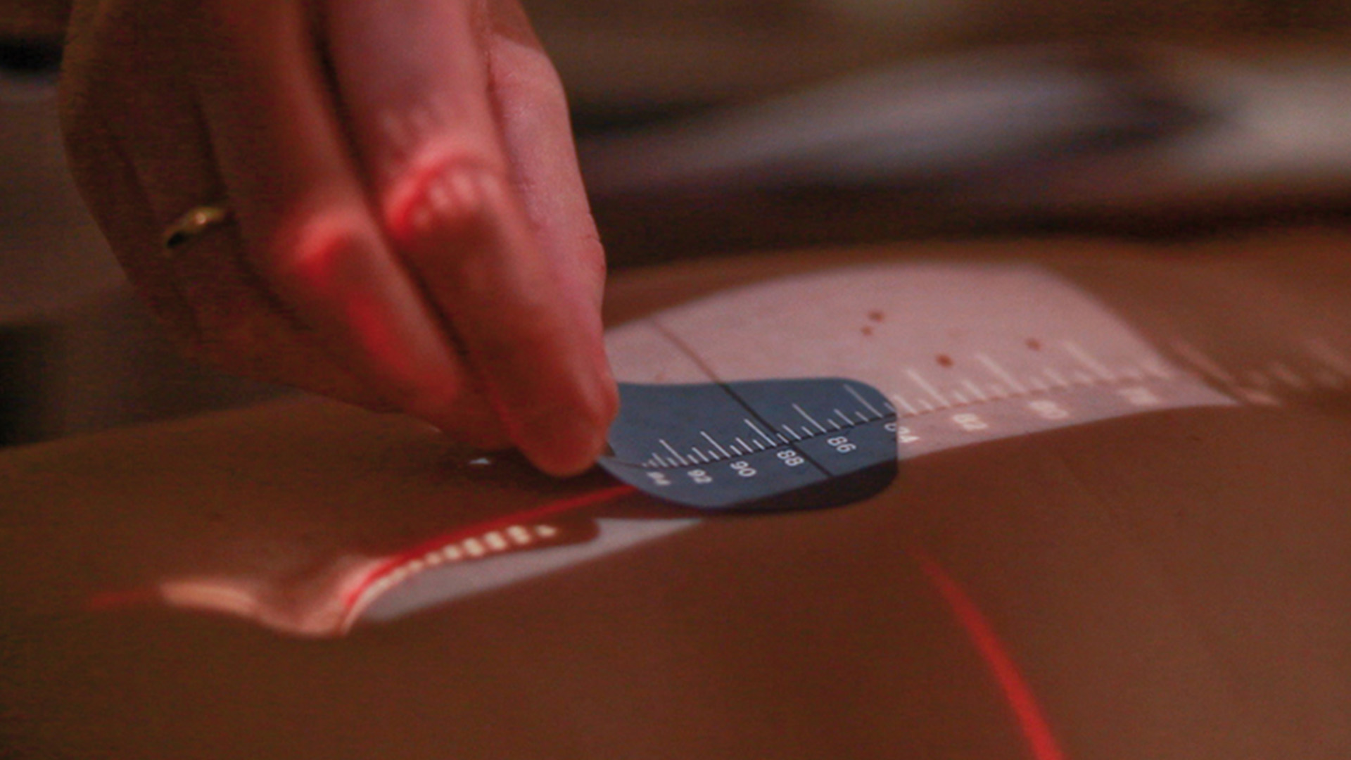 Bild Strahlentherapie Bestrahlung